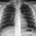 radio_thorax_nourrisson