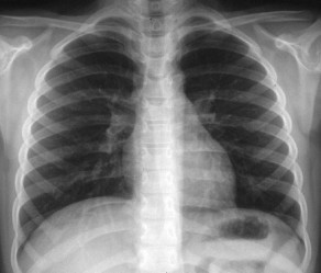 radio_thorax_nourrisson