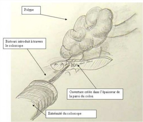 Figure 2 : Ablation du polype, découpe sous le pied du polype dans l'épaisseur de la paroi du colon grâce à un bistouri passant par le conduit du coloscope.
