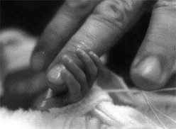 prematurite