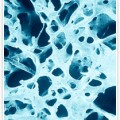 osteoporose