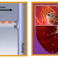 denervation renale