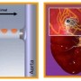 denervation renale