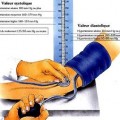 Hypertension artérielle HTA