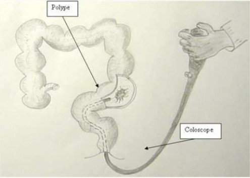 Polype du colon vu en coloscopie Figure 1: Polype du colon vu en coloscopie. La paroi du colon est représentée ouverte au niveau du polype.