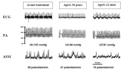denervation renale-2