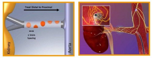 denervation renale